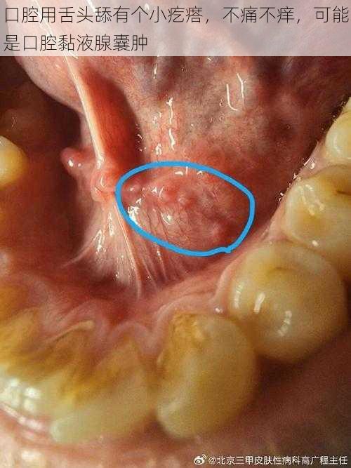 口腔用舌头舔有个小疙瘩，不痛不痒，可能是口腔黏液腺囊肿