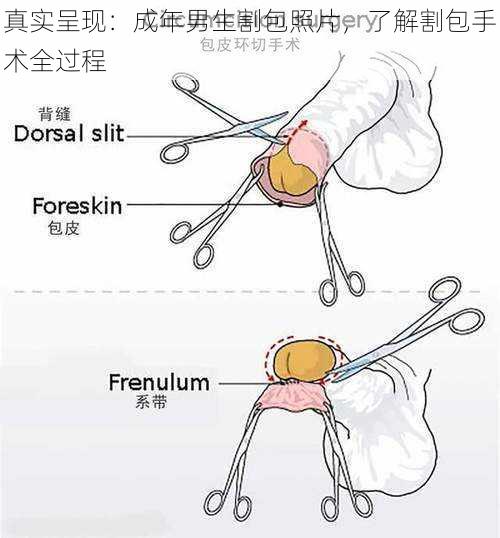 真实呈现：成年男生割包照片，了解割包手术全过程